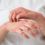 Protecting Children and Pregnant Moms from Monkeypox